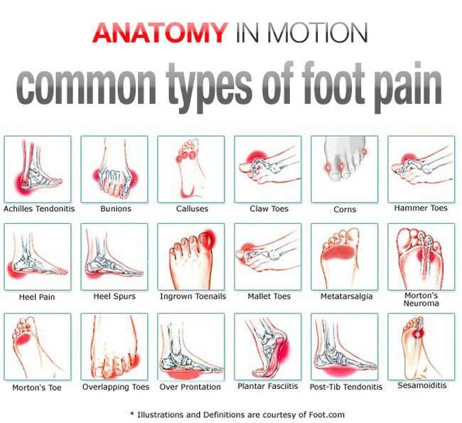 Common Foot Ailments The Shoe Fits